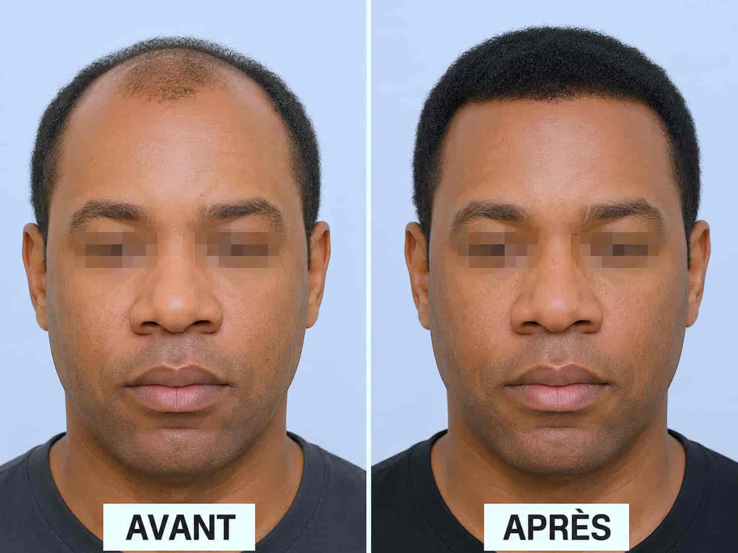 Greffe capillaire Bordeaux