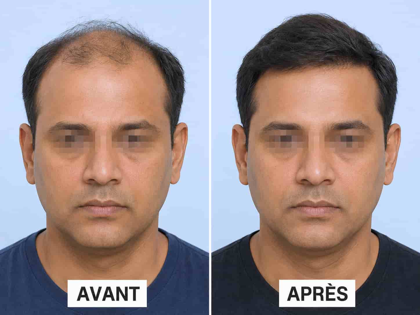Clinique greffe cheveux Nancy