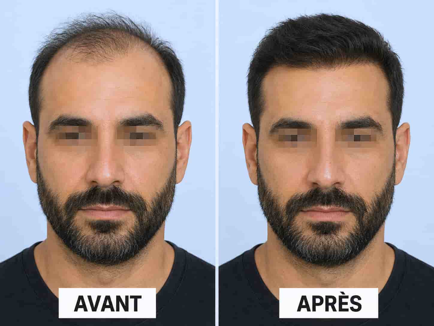 clinique greffe cheveux Nancy résultat 2
