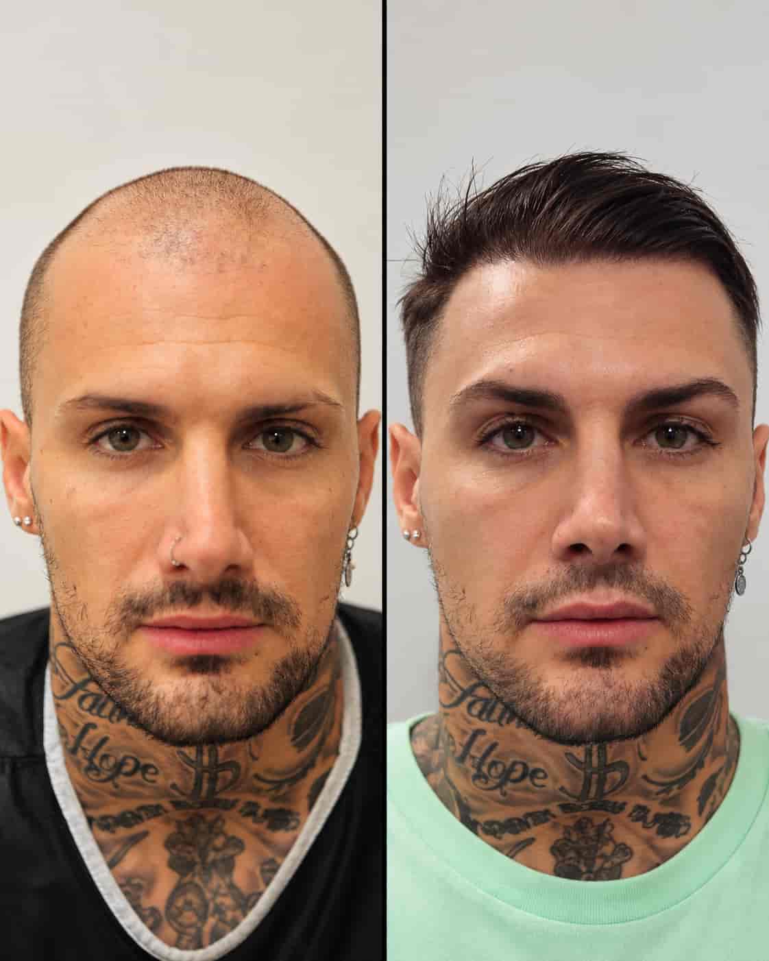 Hair transplant Turkey before and after - patient 1