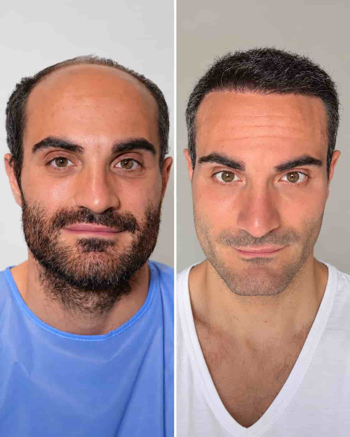 Hair transplant Turkey before and after - patient 10
