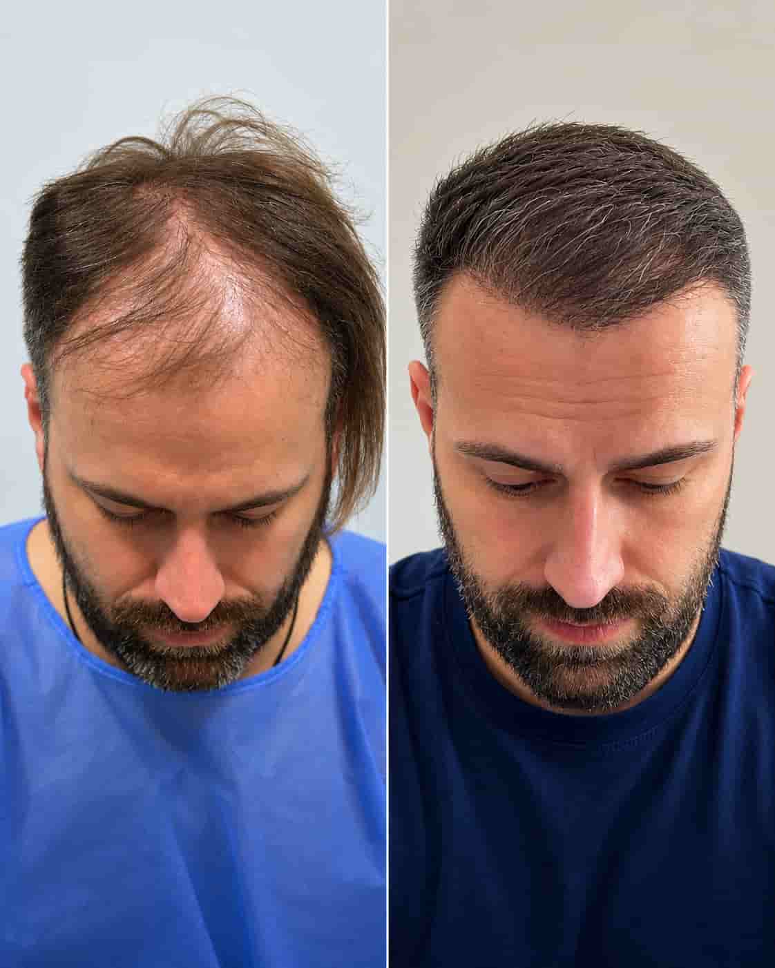 Hair transplant Turkey before and after - patient 11