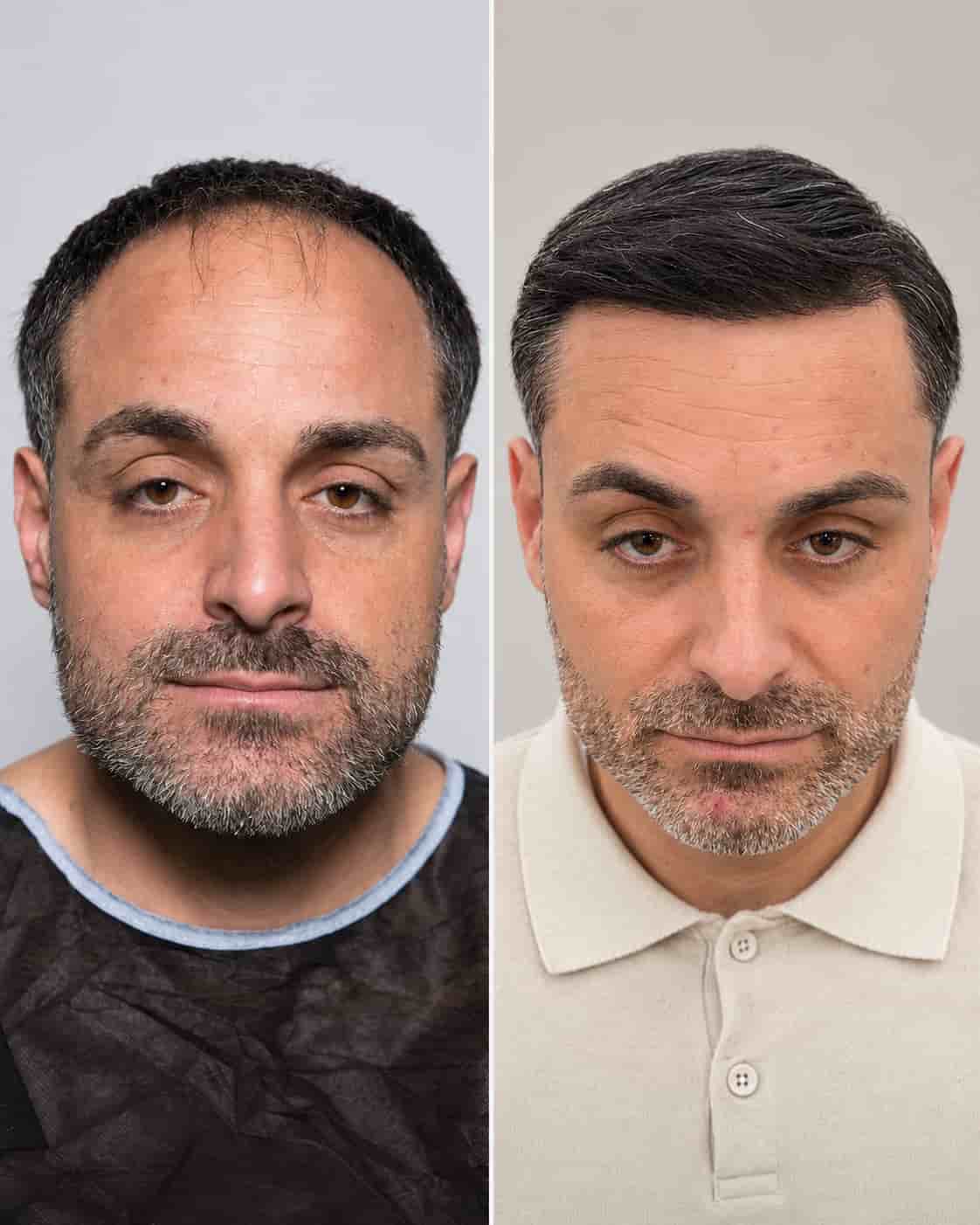 Hair transplant Turkey before and after - patient 12
