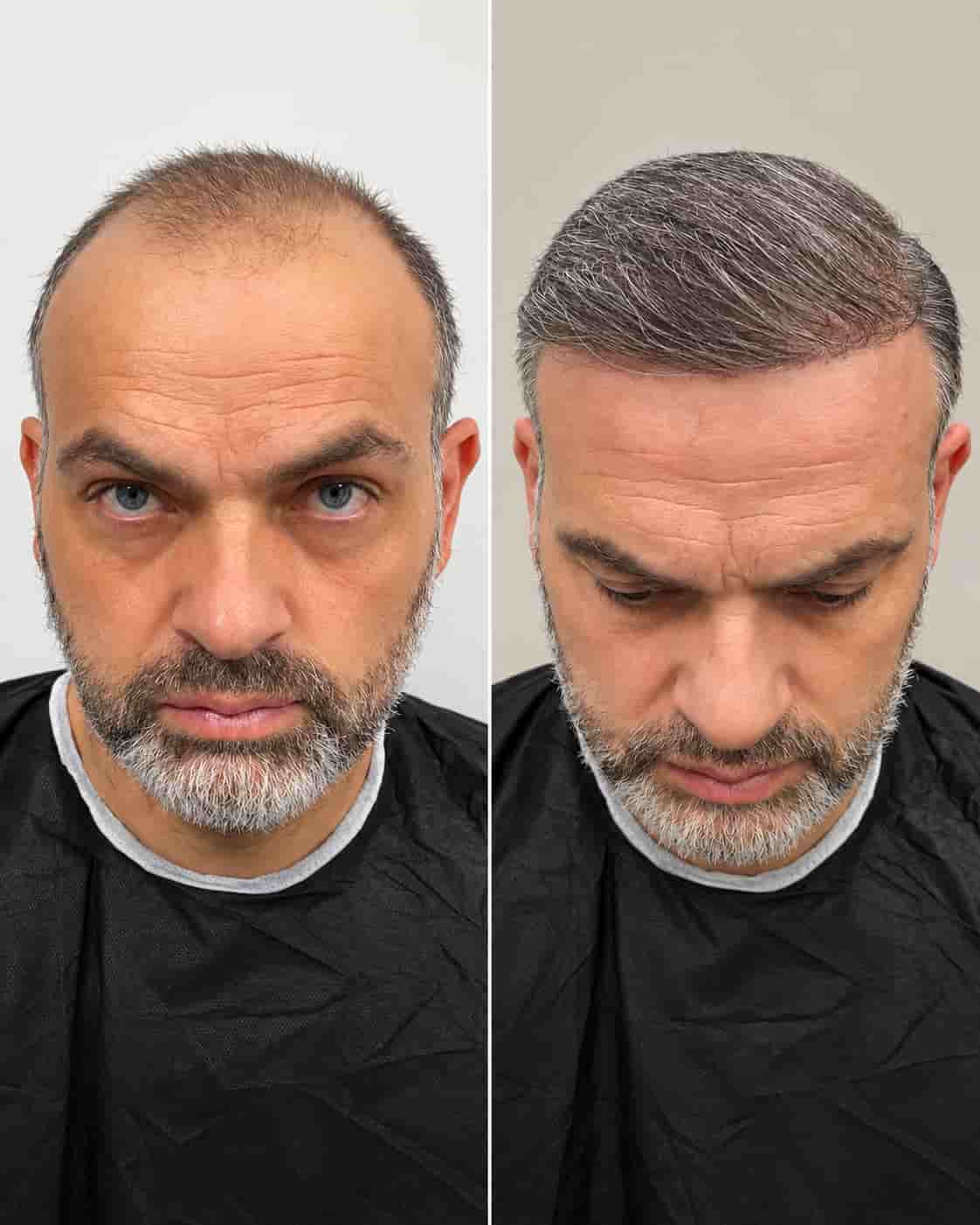 Hair transplant before-and-after example; individual results vary