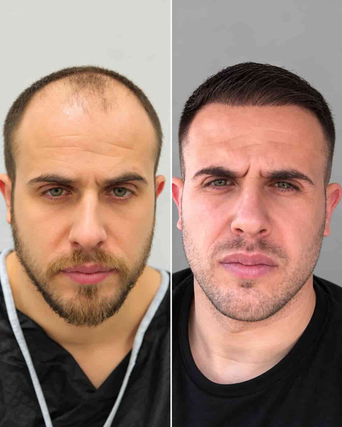 Hair transplant Turkey before and after - patient 14