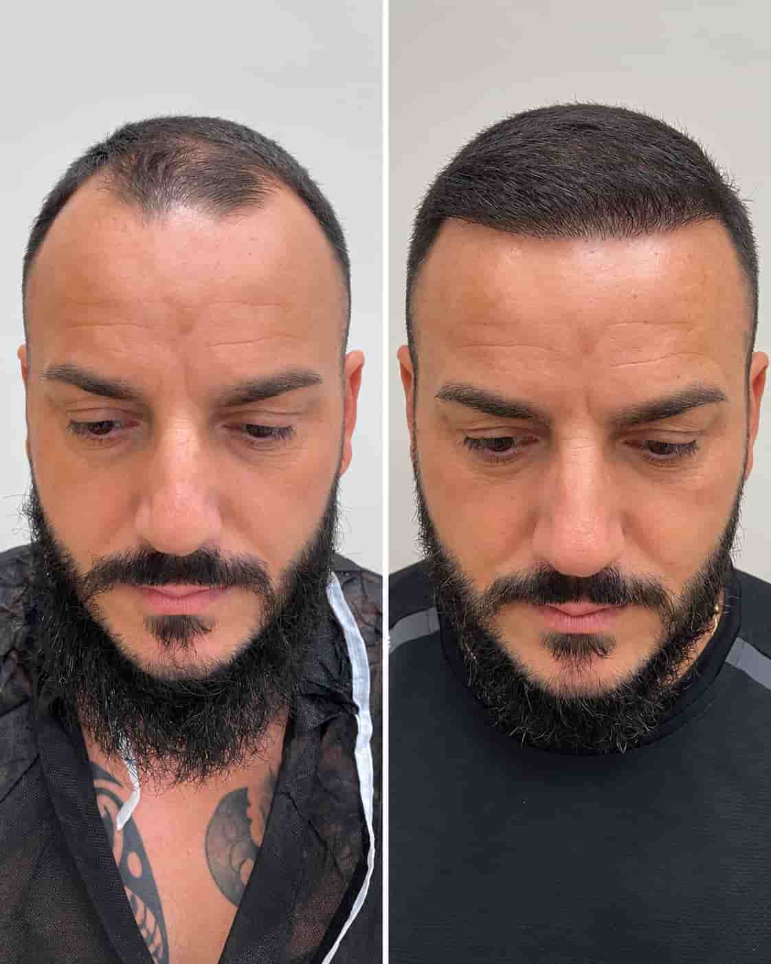 Hair transplant Turkey before and after - patient 15