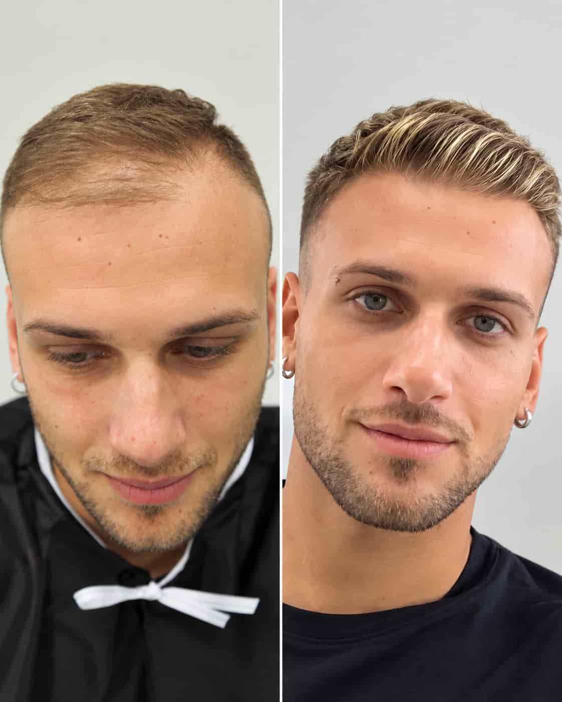 Hair transplant before-and-after example; individual results vary
