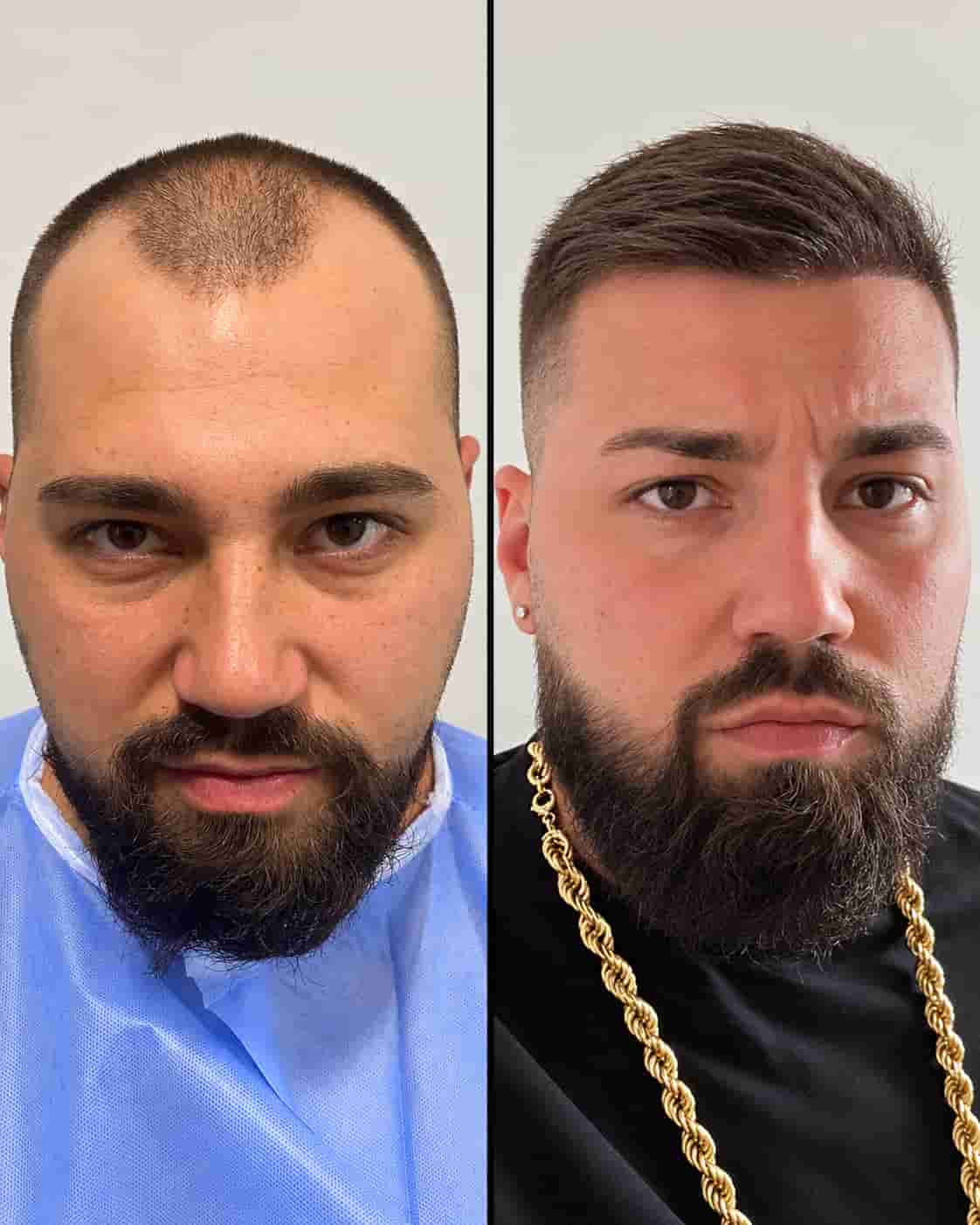 Hair transplant Turkey before and after - patient 17