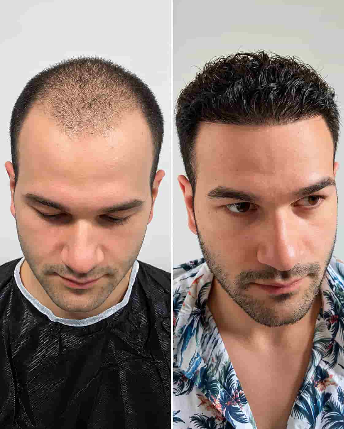 Hair transplant Turkey before and after - patient 18