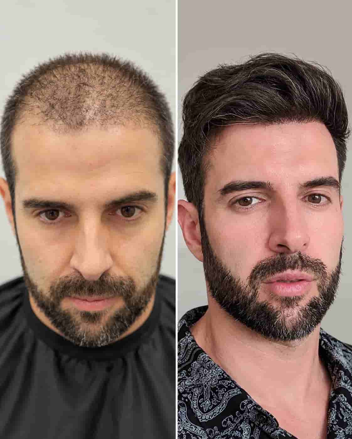 Hair transplant Turkey before and after - patient 19