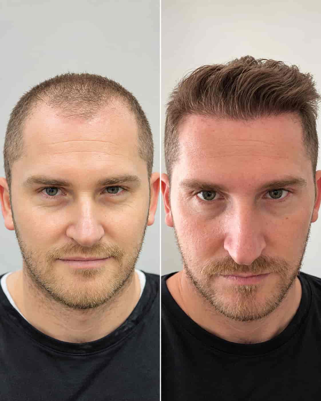Hair transplant Turkey before and after - patient 2