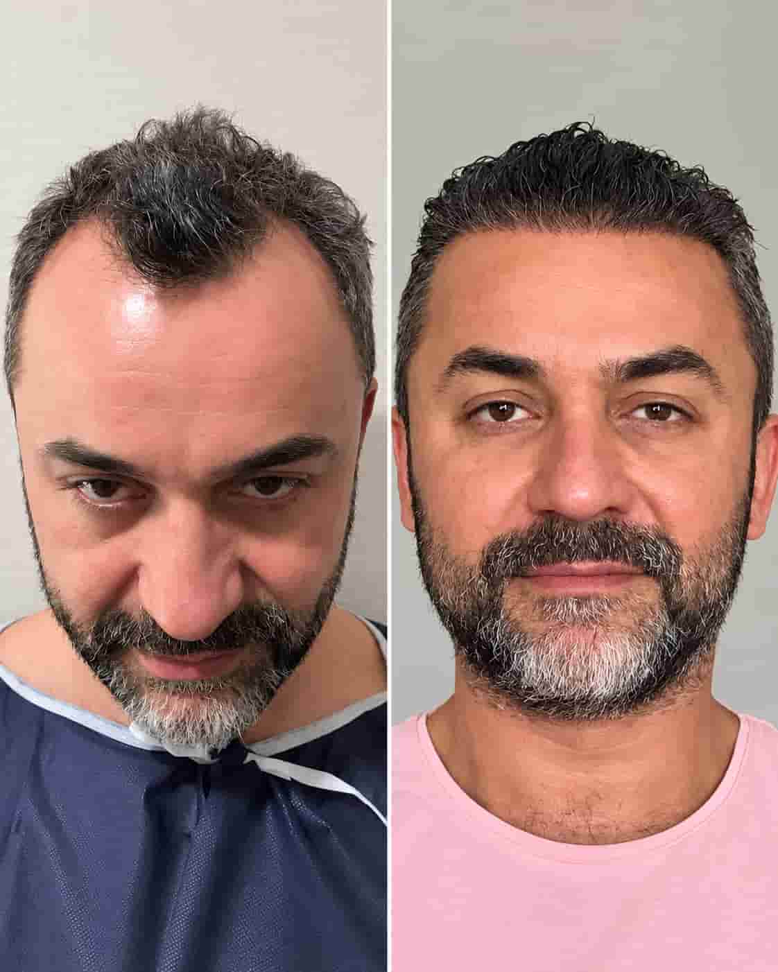 Hair transplant before-and-after example; individual results vary