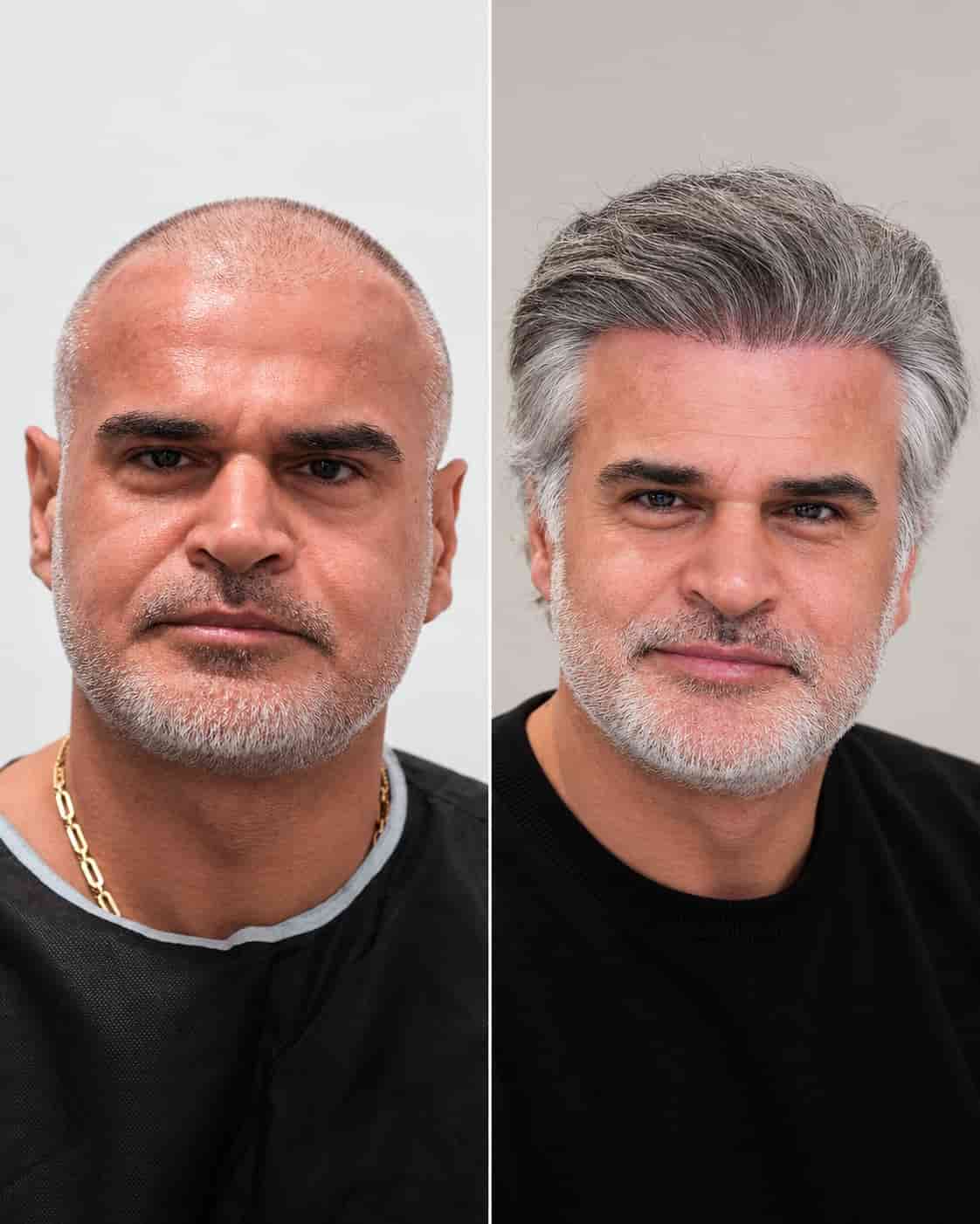 Hair transplant before-and-after example; individual results vary