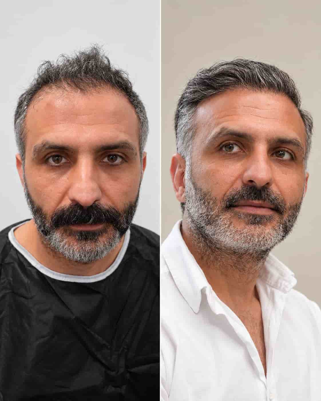 Hair transplant Turkey before and after - patient 4