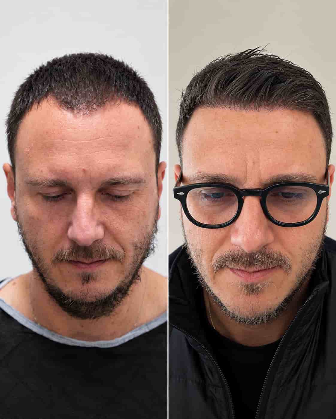 Hair transplant before-and-after example; individual results vary