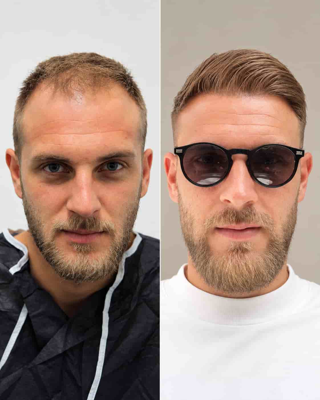 Hair transplant Turkey before and after - patient 6
