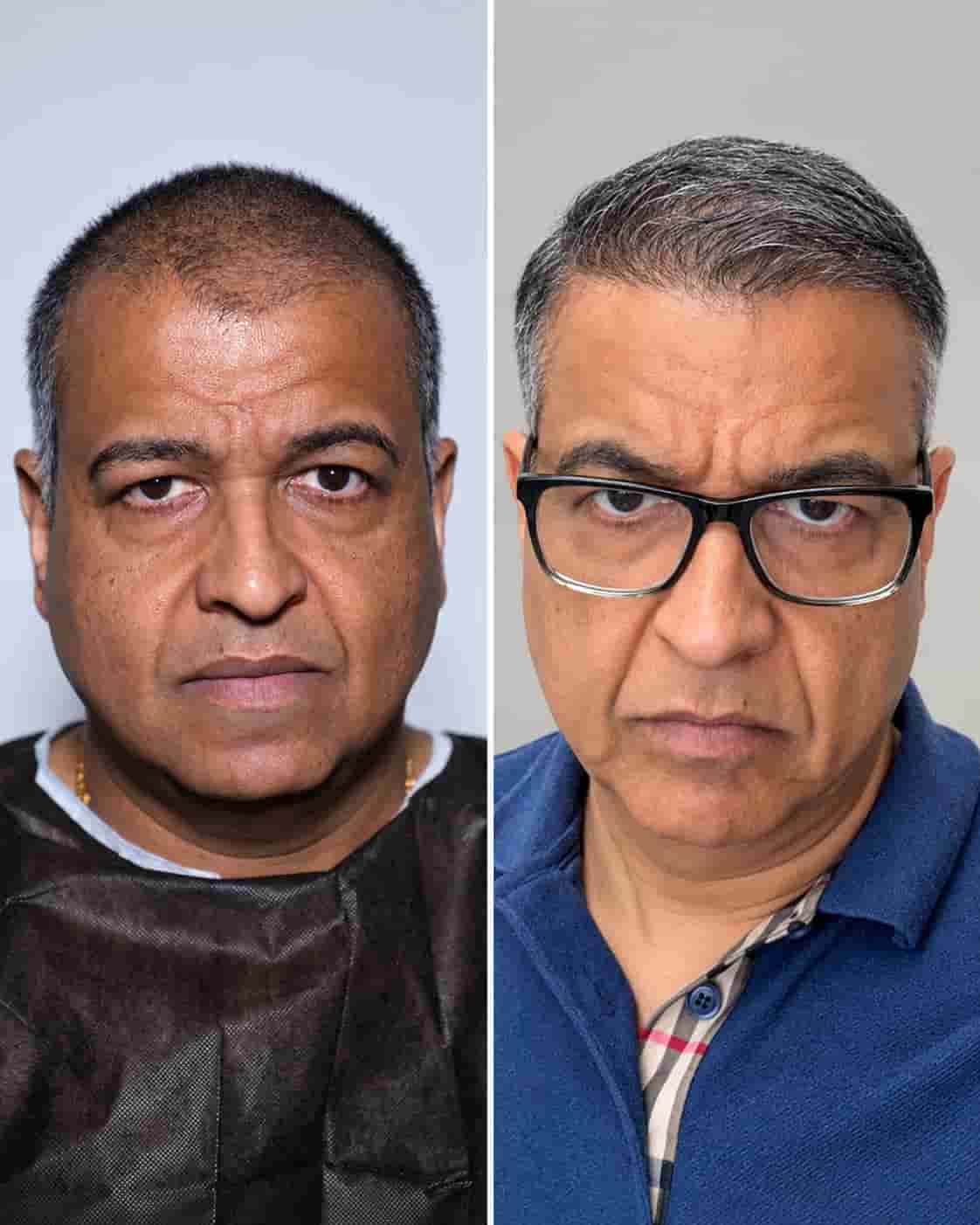 Hair transplant Turkey before and after - patient 7