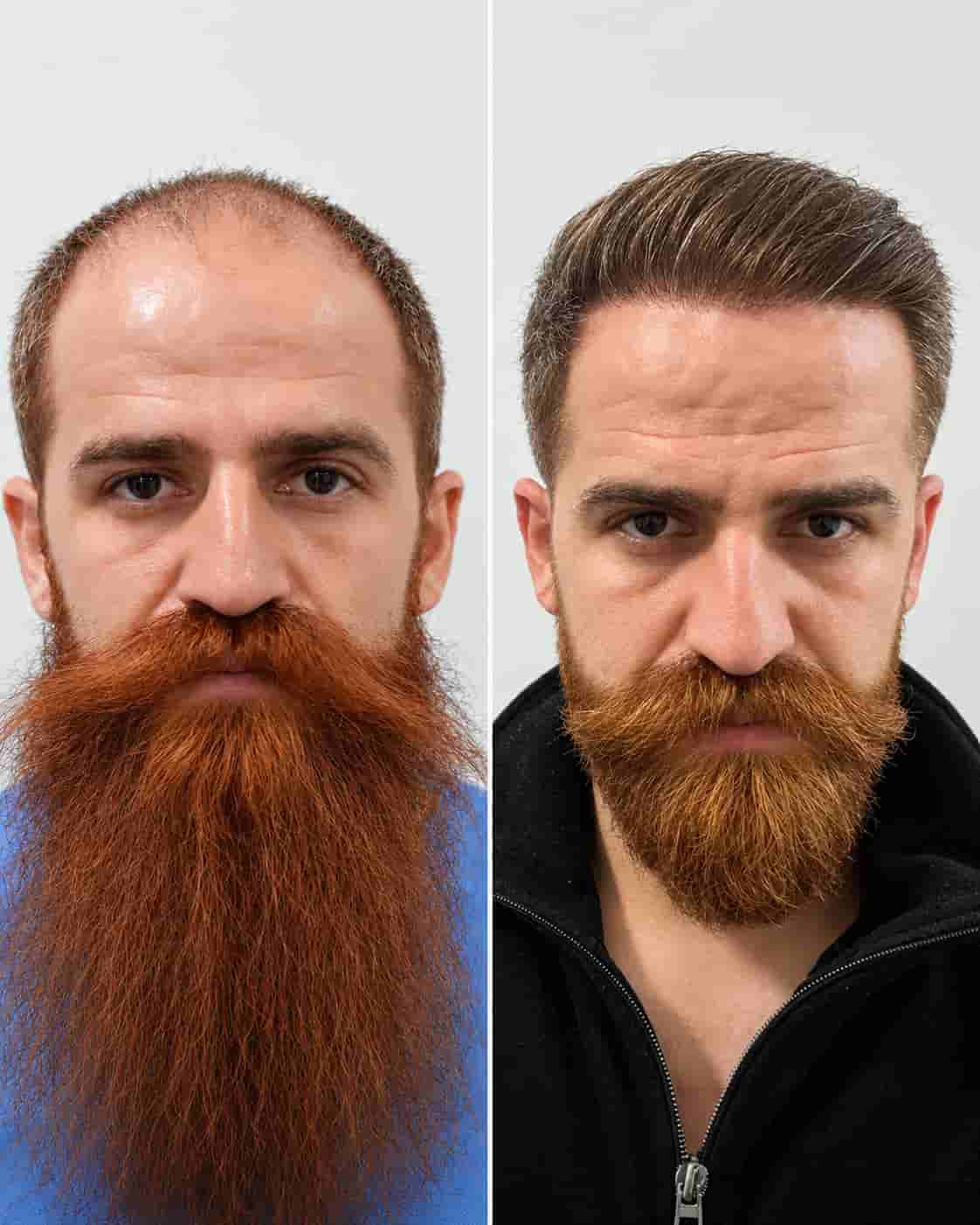 Hair transplant before-and-after example; individual results vary