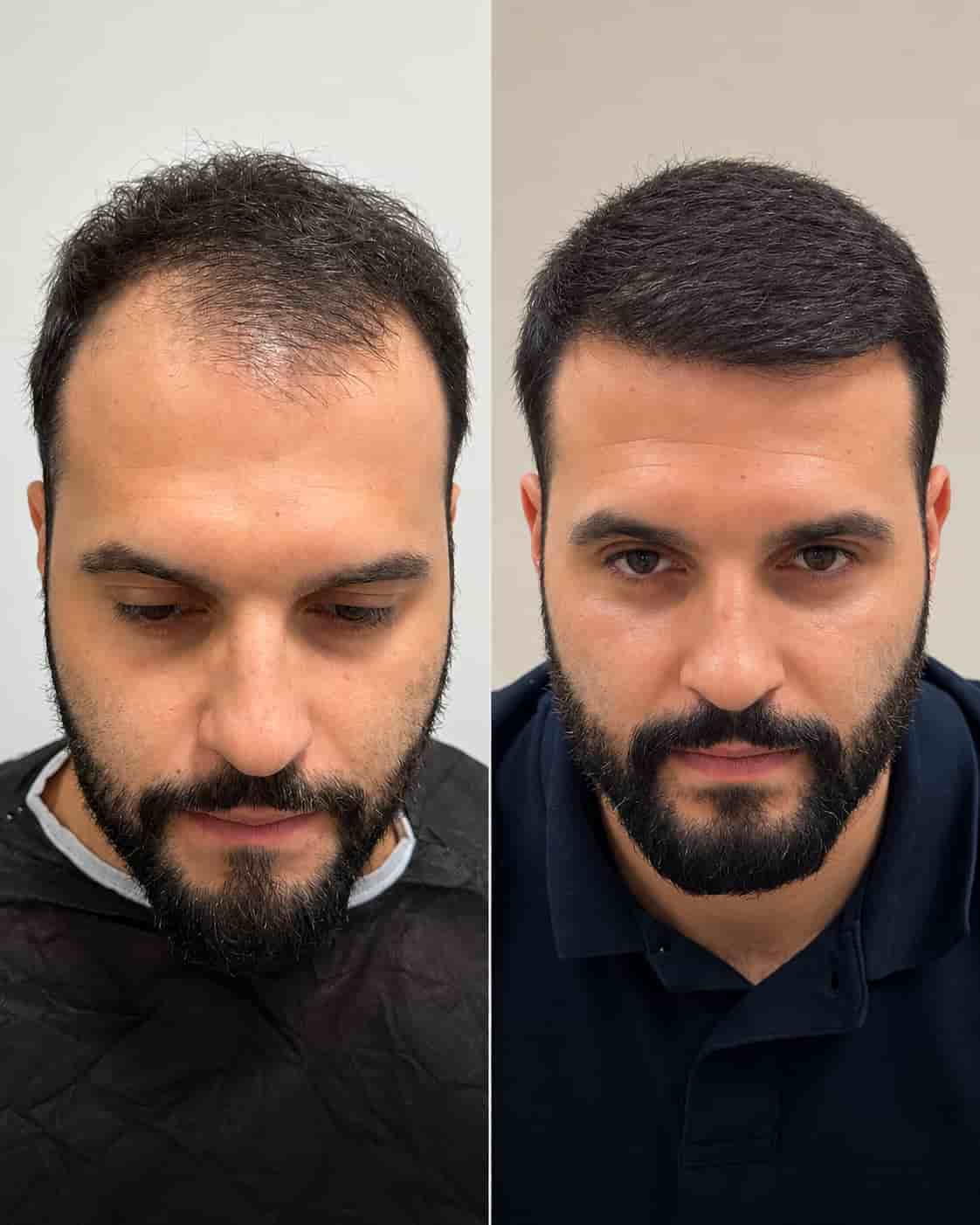 Hair transplant Turkey before and after - patient 9